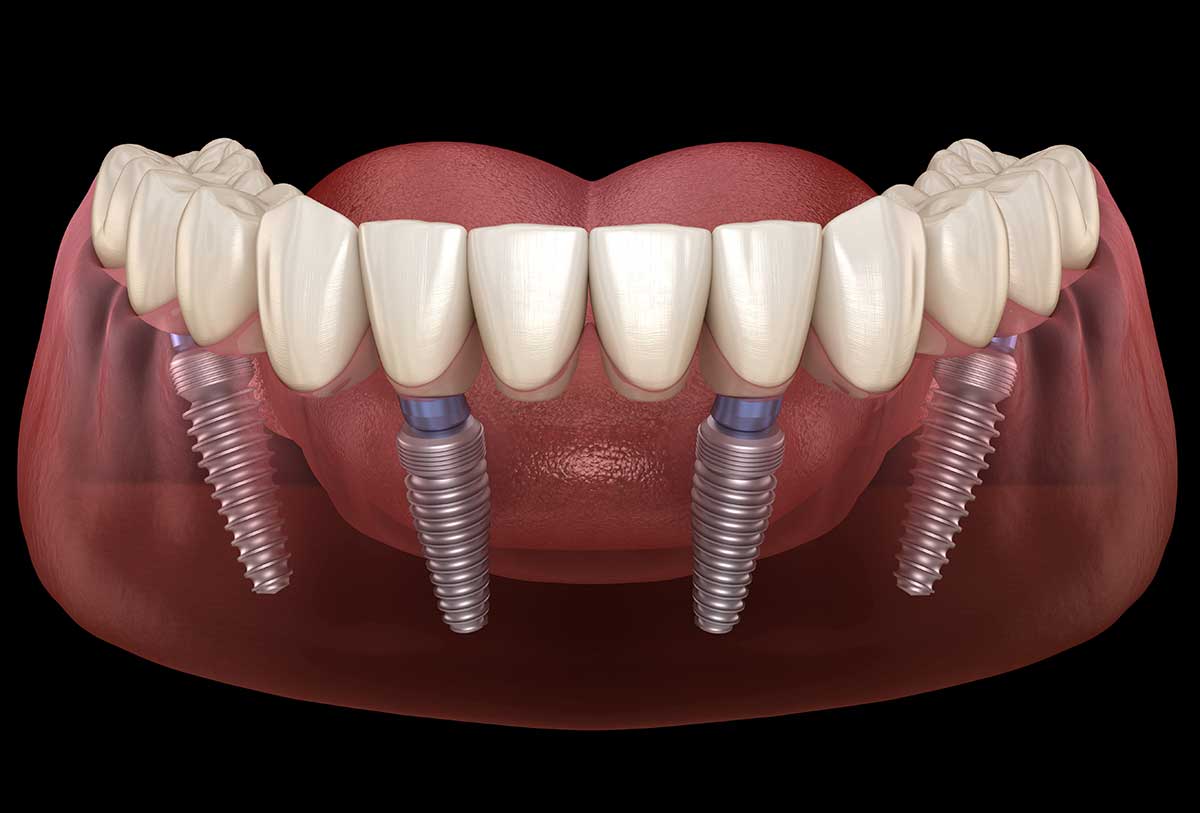 Illustration of how the bottom arch of all-on-4 implants look in one's mouth.