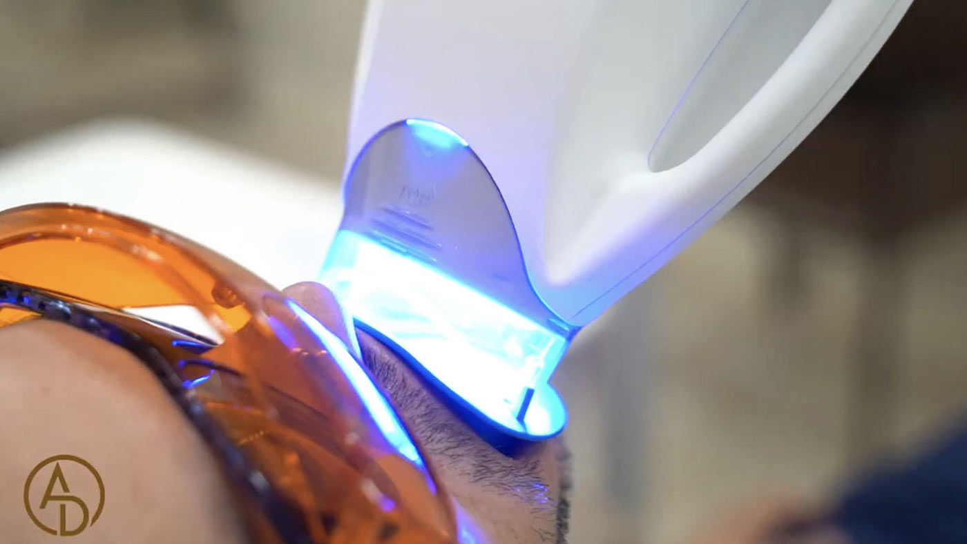 A close-up of a person having their teeth whitened with a blue light.