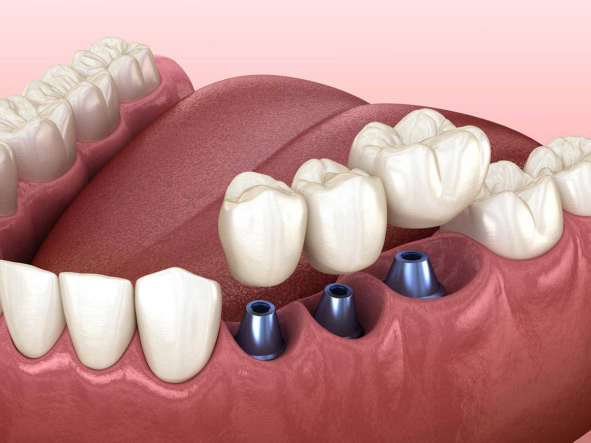 A set of three dental implants with a bridge of three crowns to replace missing teeth.