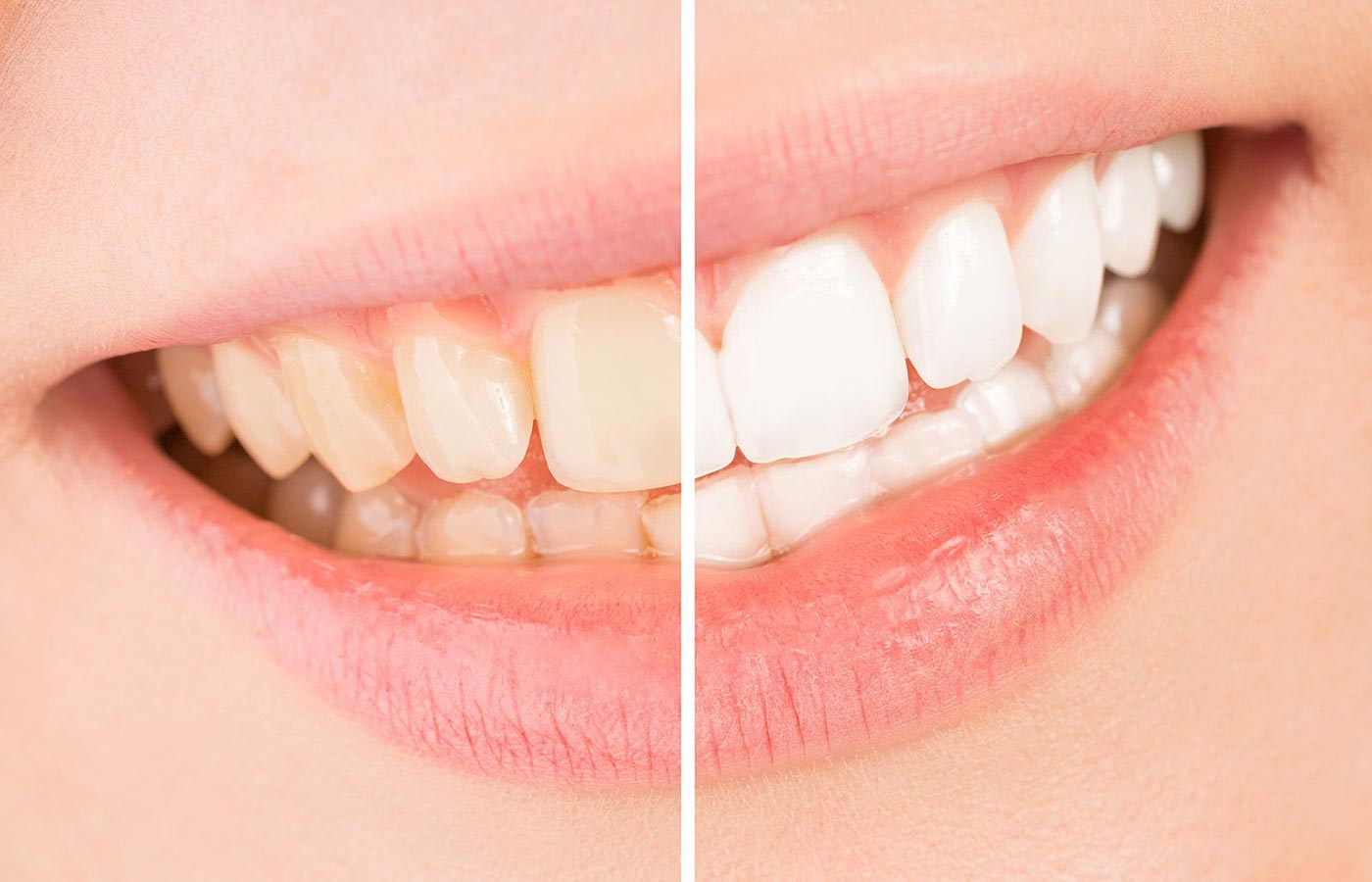 A close-up of a person's teeth before and after whitening.