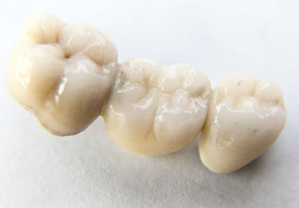 Tooth Under the Dental Bridge | Aesthetic Dental & Specialty Center