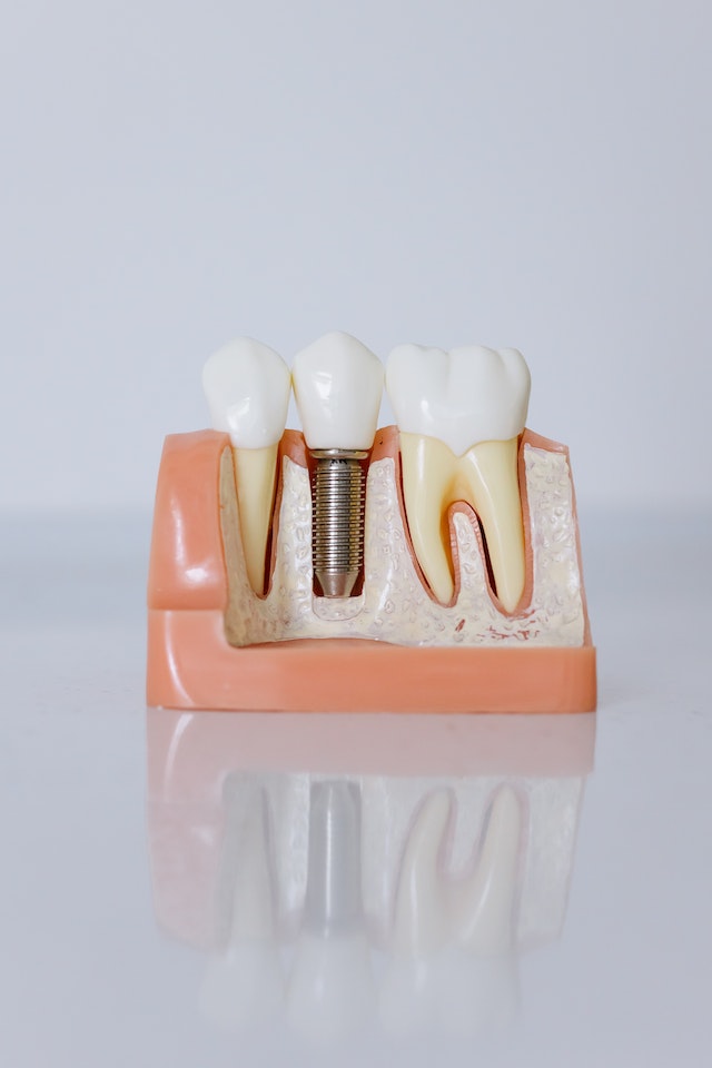 A model of a dental implant in between two natural teeth.