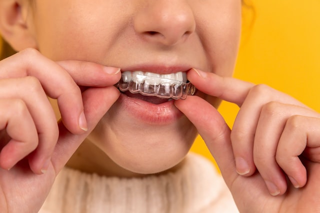 Closeup of a girl putting in Invisalign clear aligners